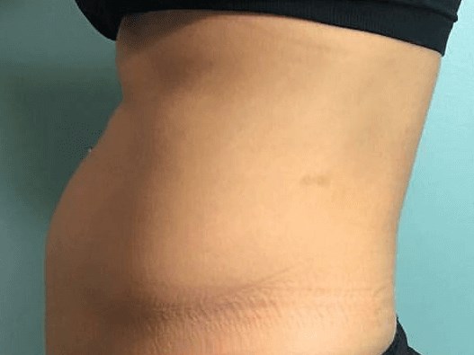 Before and After TruSculpt 3D Before