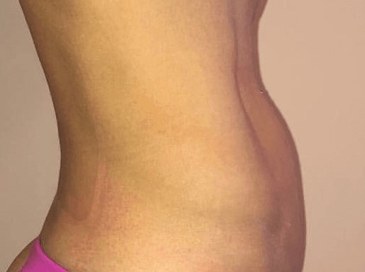 Before and After TruSculpt 3D After