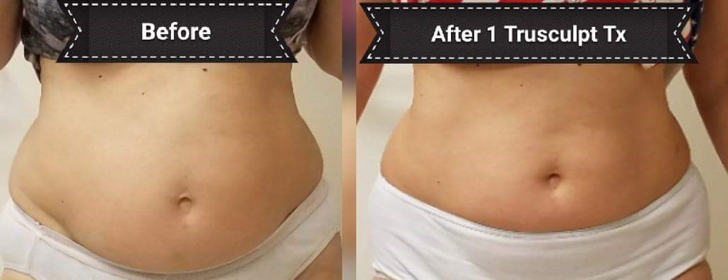 Before and After TruSculpt 3D Before