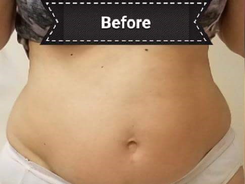 Before and After TruSculpt 3D Before