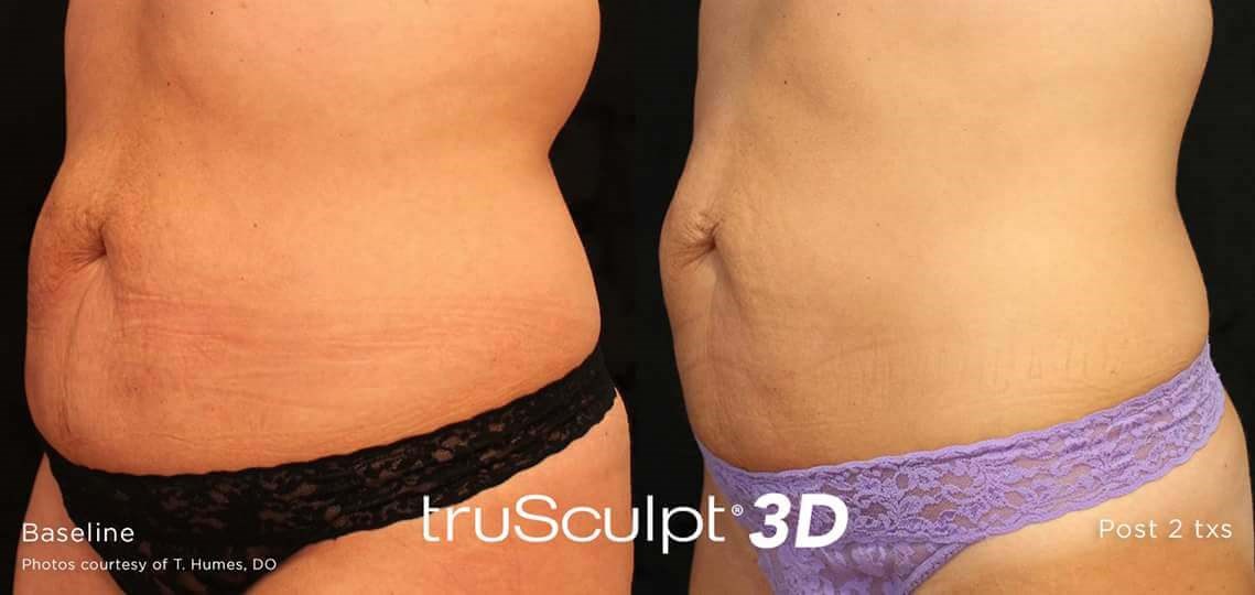 Before and After TruSculpt 3D Before