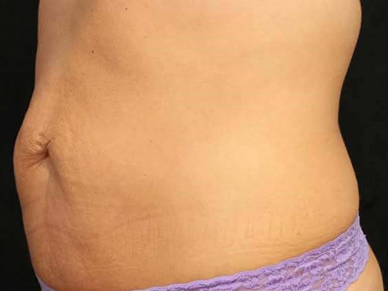 Before and After TruSculpt 3D After