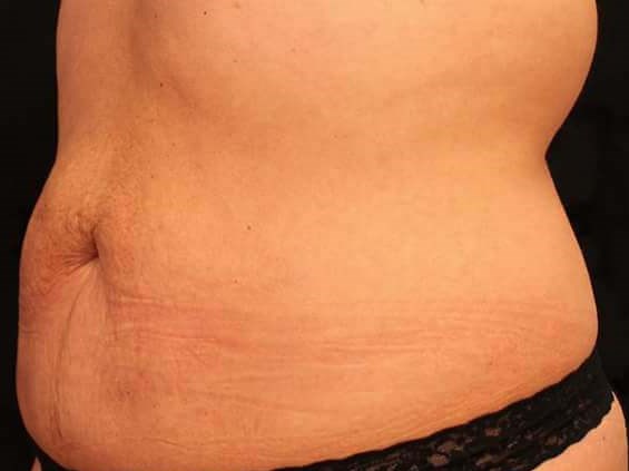 Before and After TruSculpt 3D Before