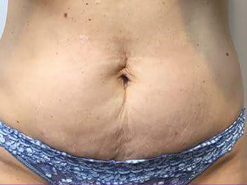 Before and After TruSculpt 3D Before