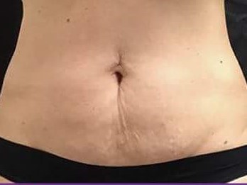 Before and After TruSculpt 3D After