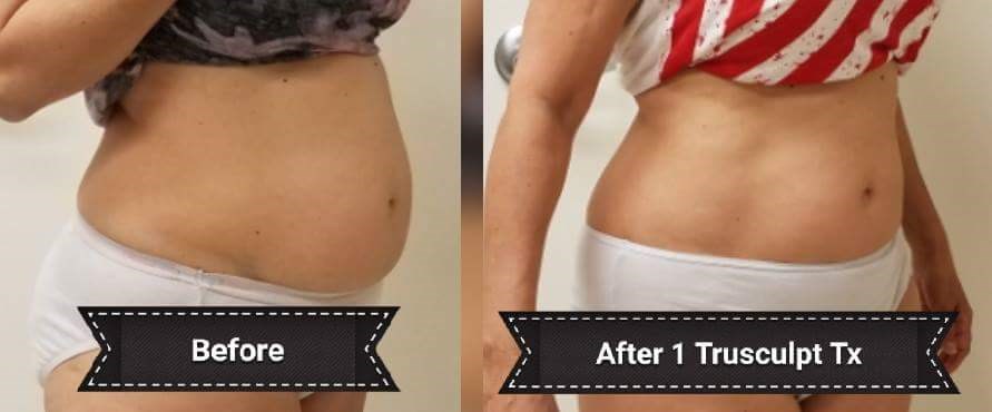 Before and After TruSculpt 3D Before