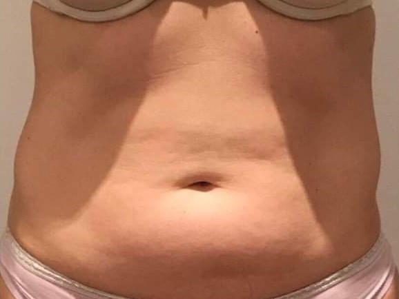 Before and After TruSculpt 3D Before