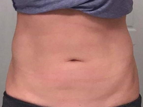 Before and After TruSculpt 3D After