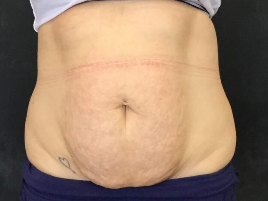 Before and After TightSculpt After