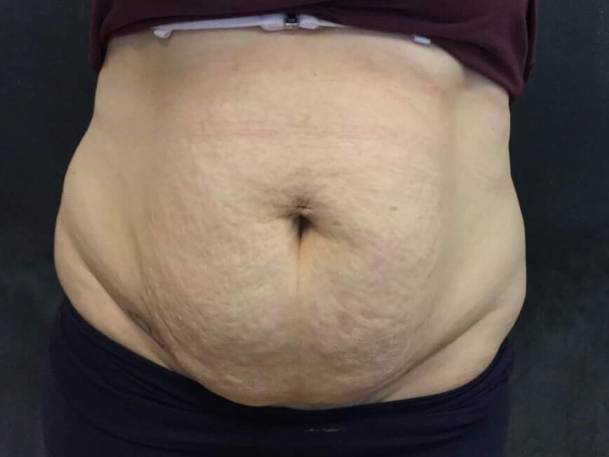 Before and After TightSculpt Before