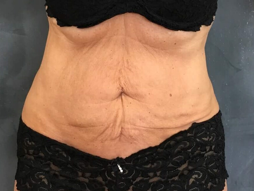 Before and After TightSculpt Before