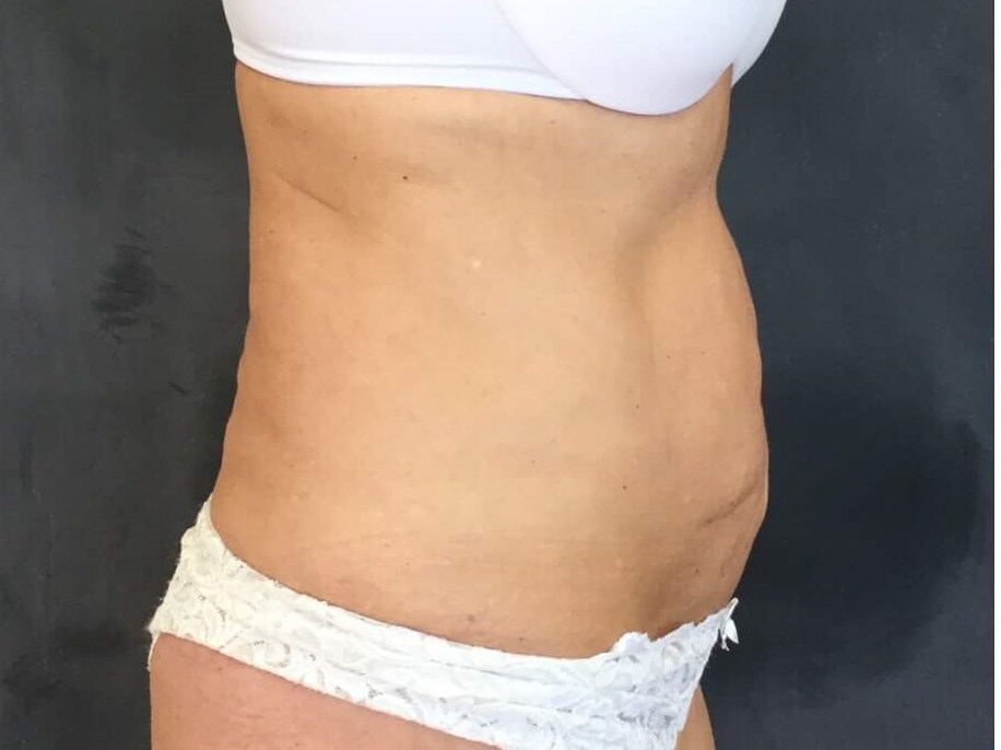 Before and After TightSculpt After