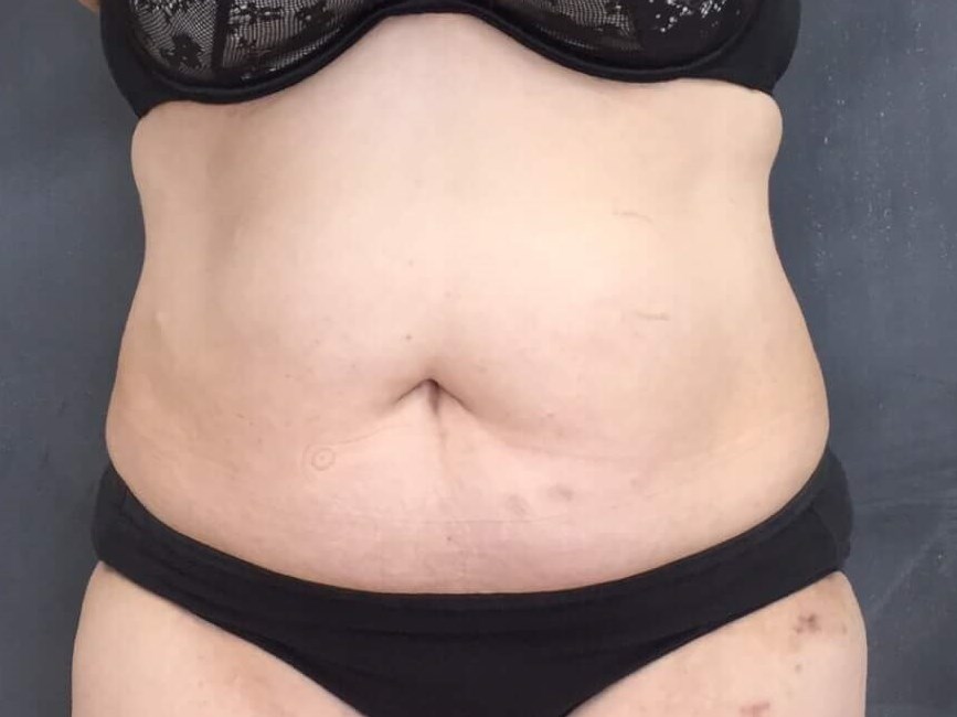 Before and After TightSculpt After