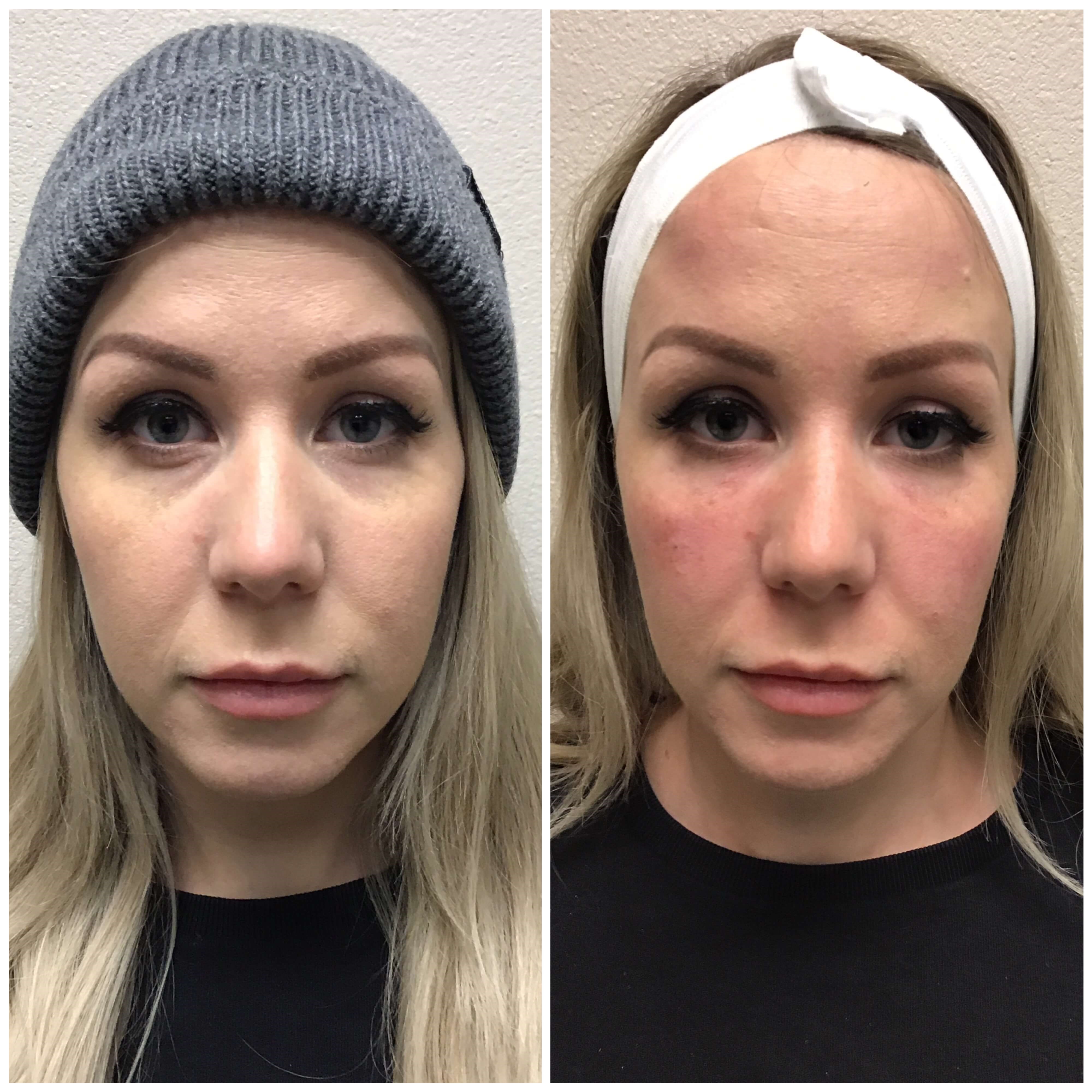Before & After Dermal Filler Before
