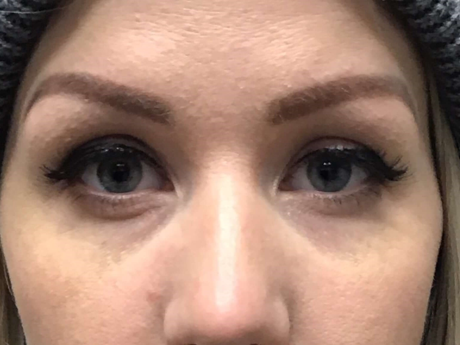 Before & After Dermal Filler Before