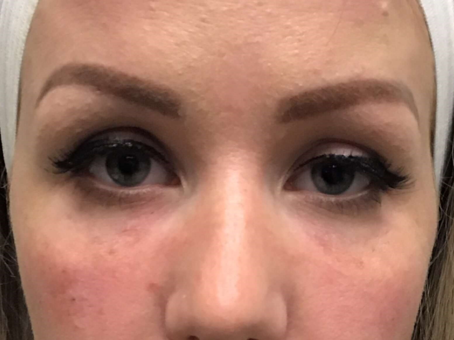 Before & After Dermal Filler After