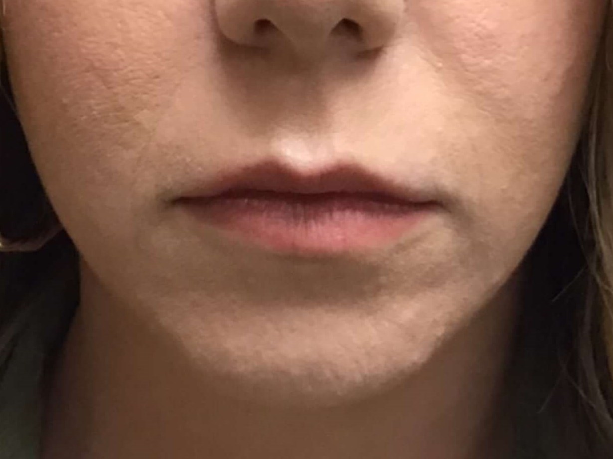 Before and After Lip Filler Before