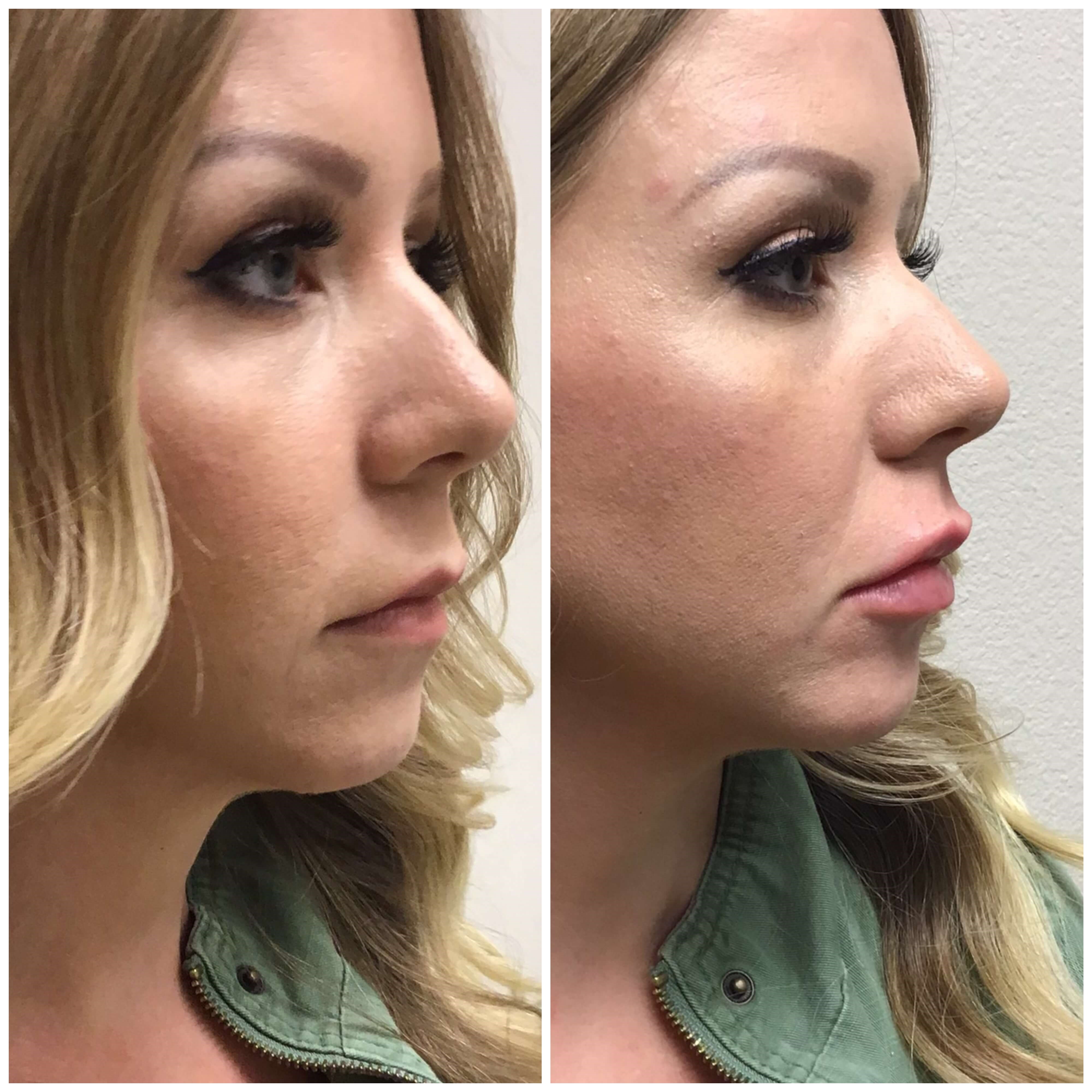 Before and After Lip Filler Before
