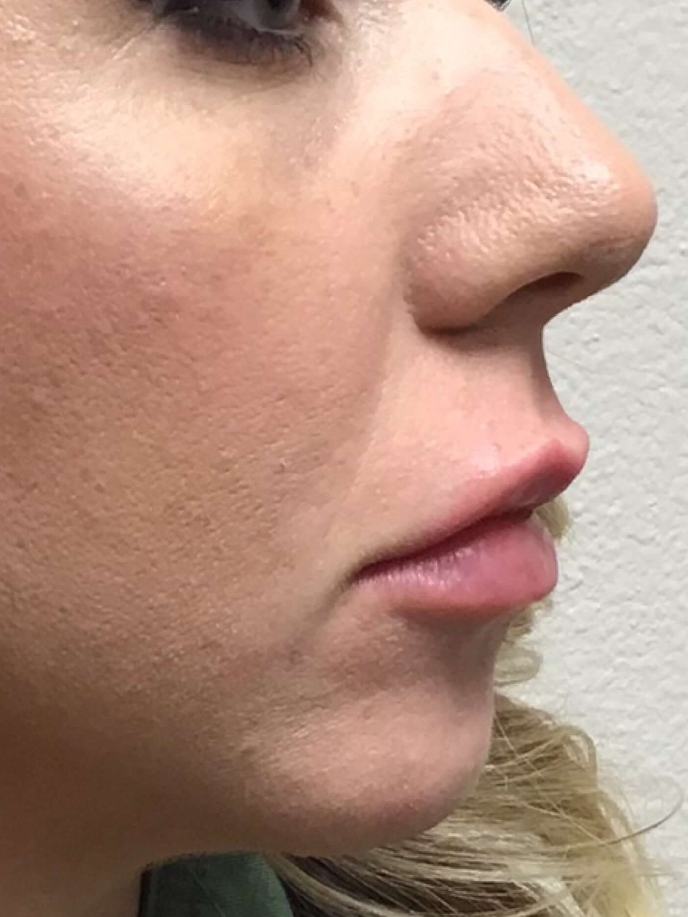 Before and After Lip Filler After