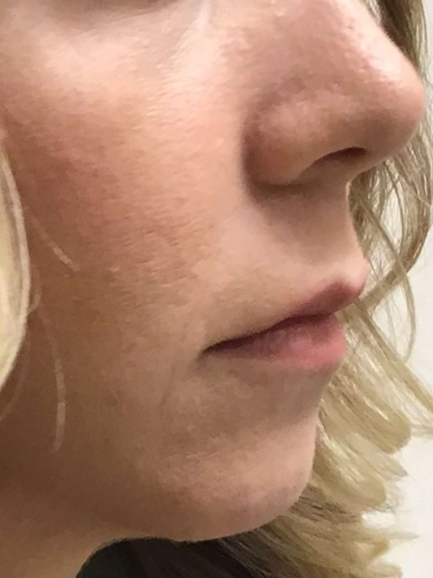 Before and After Lip Filler Before