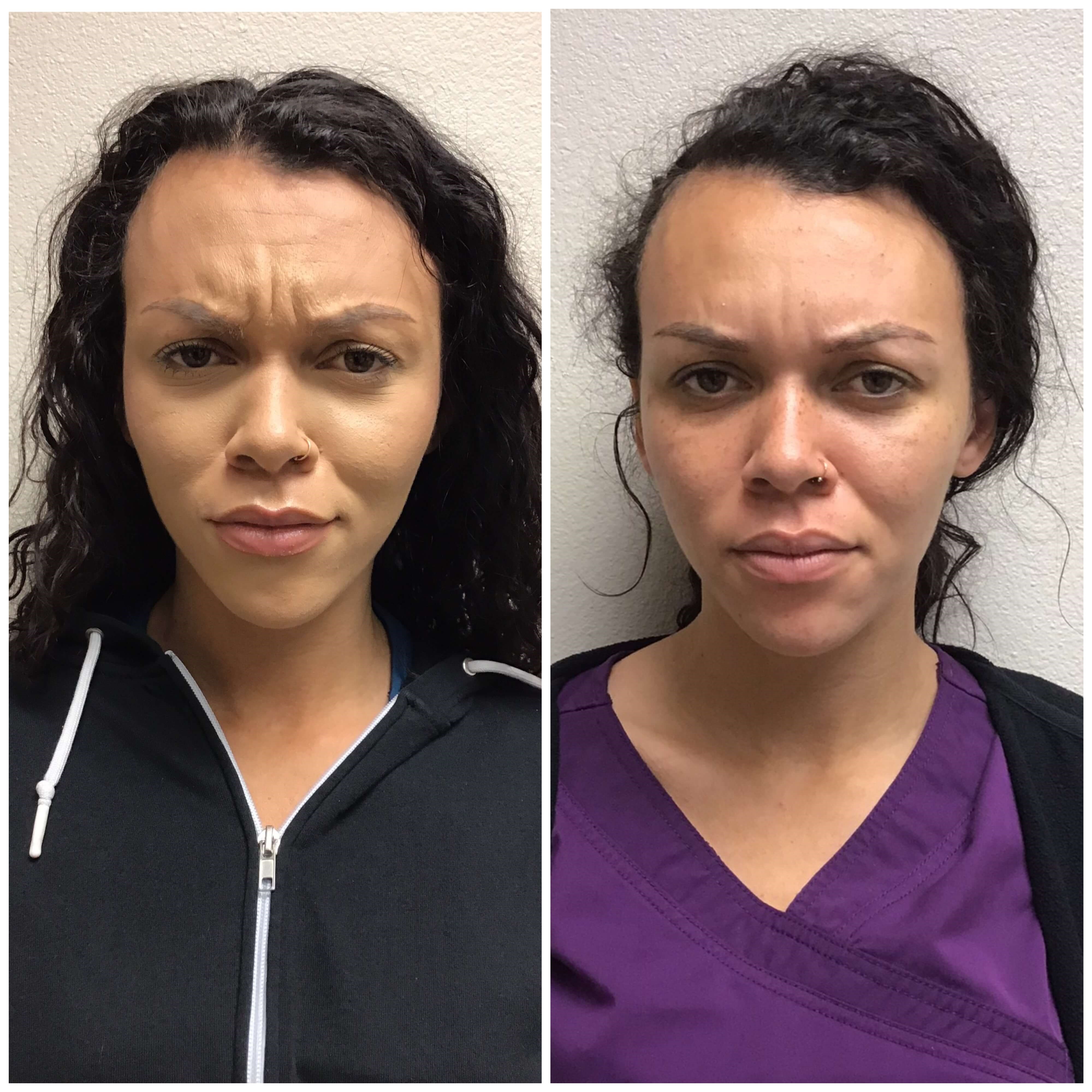 Before and After Botox Before