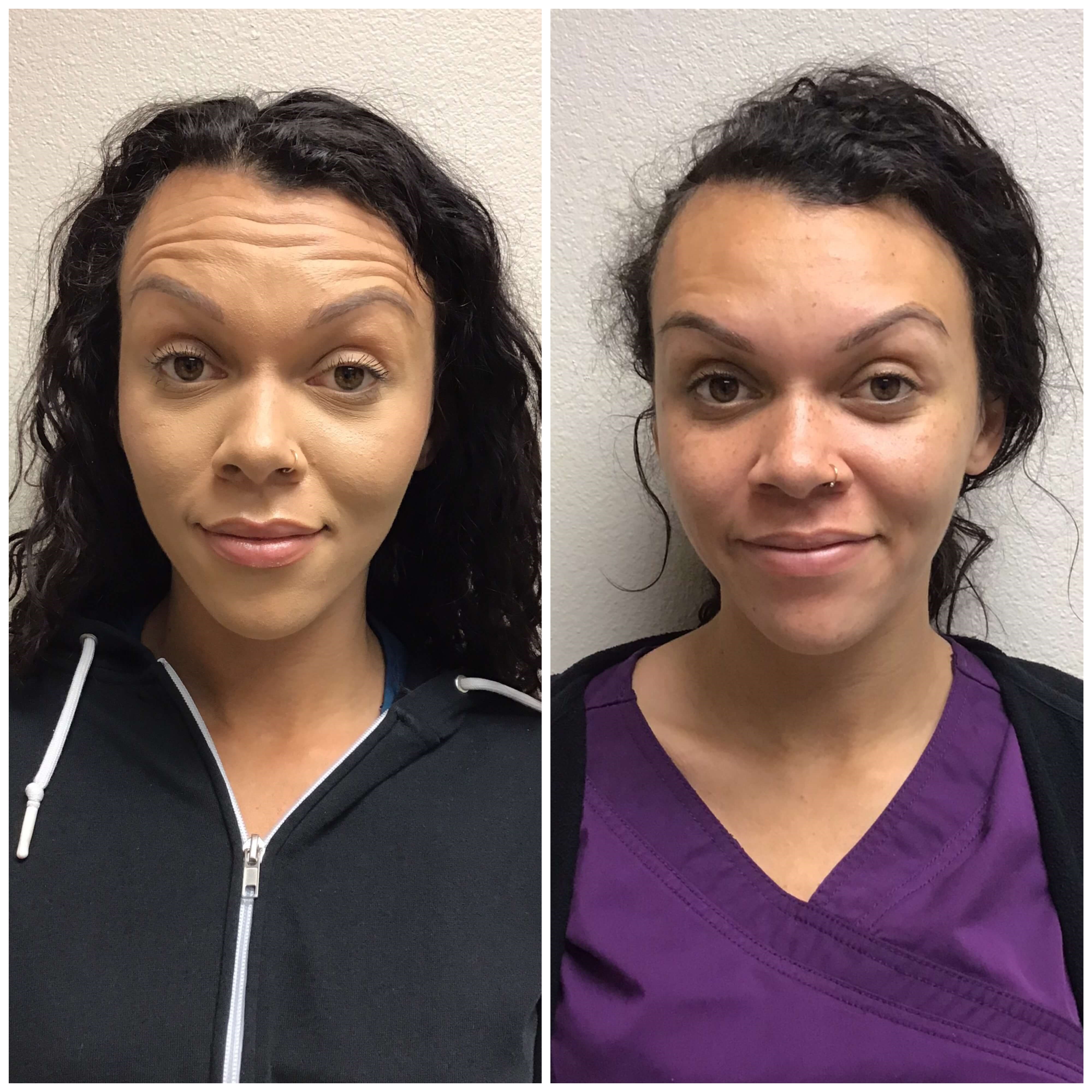 Before and After Botox Before