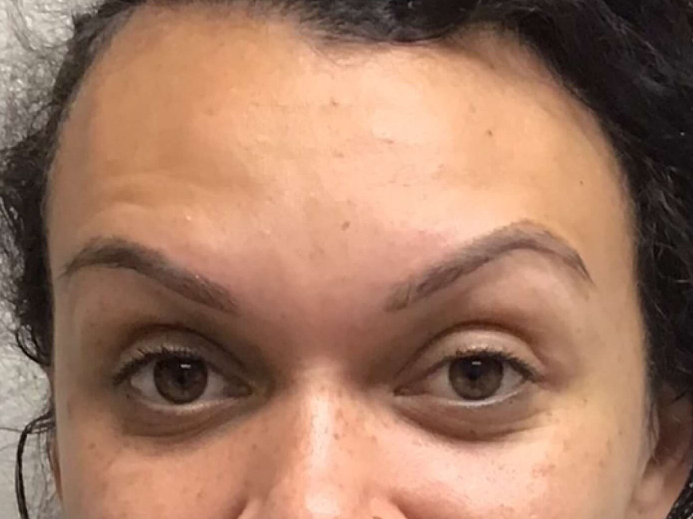 Before and After Botox After