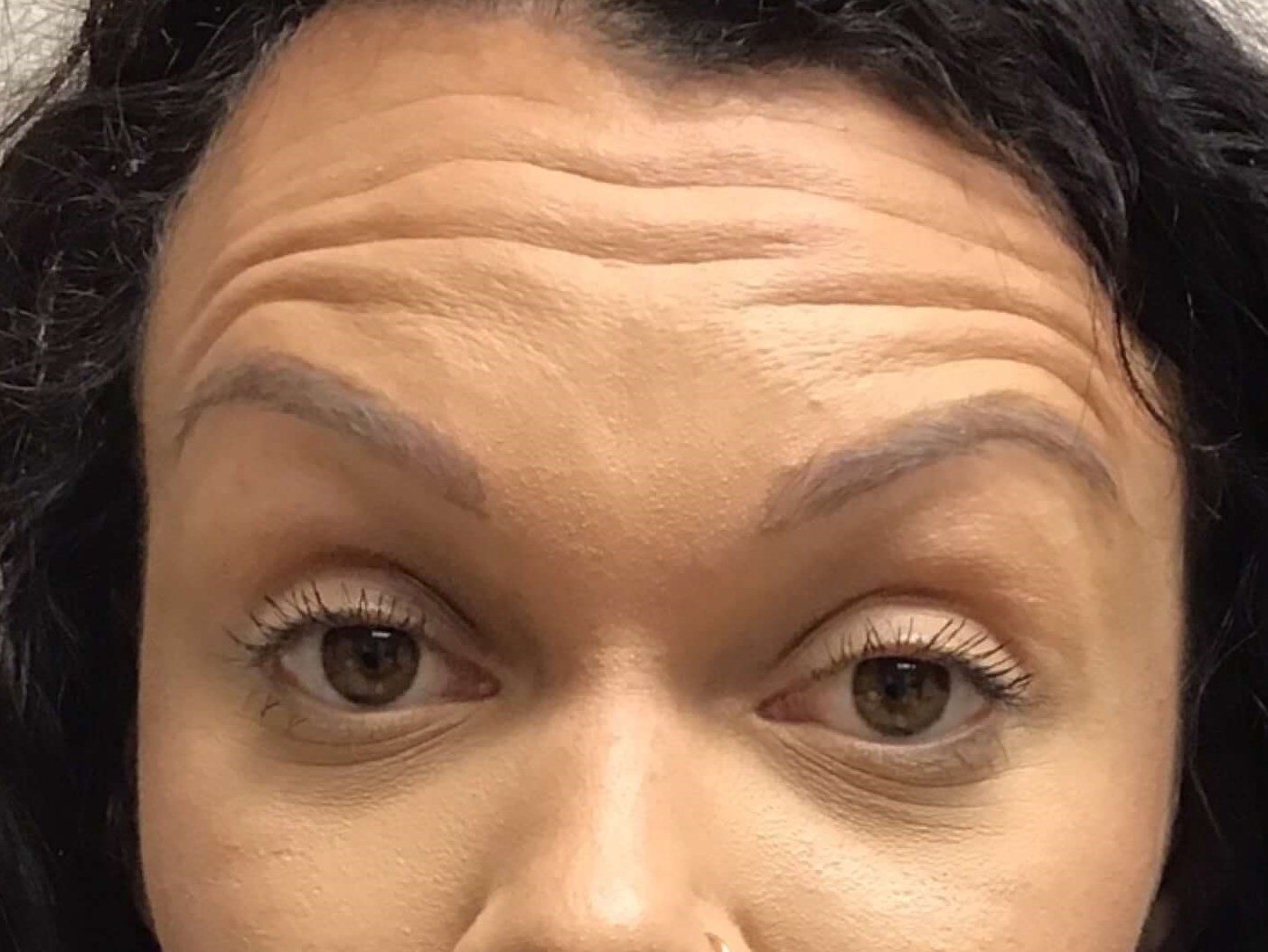 Before and After Botox Before