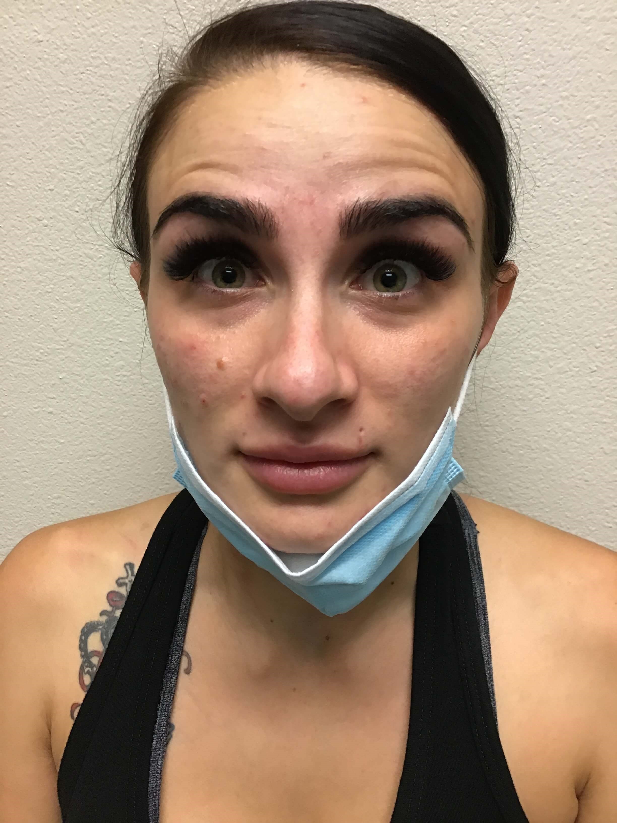 Before and After Lip Filler Before