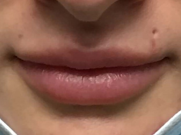 Before and After Lip Filler Before