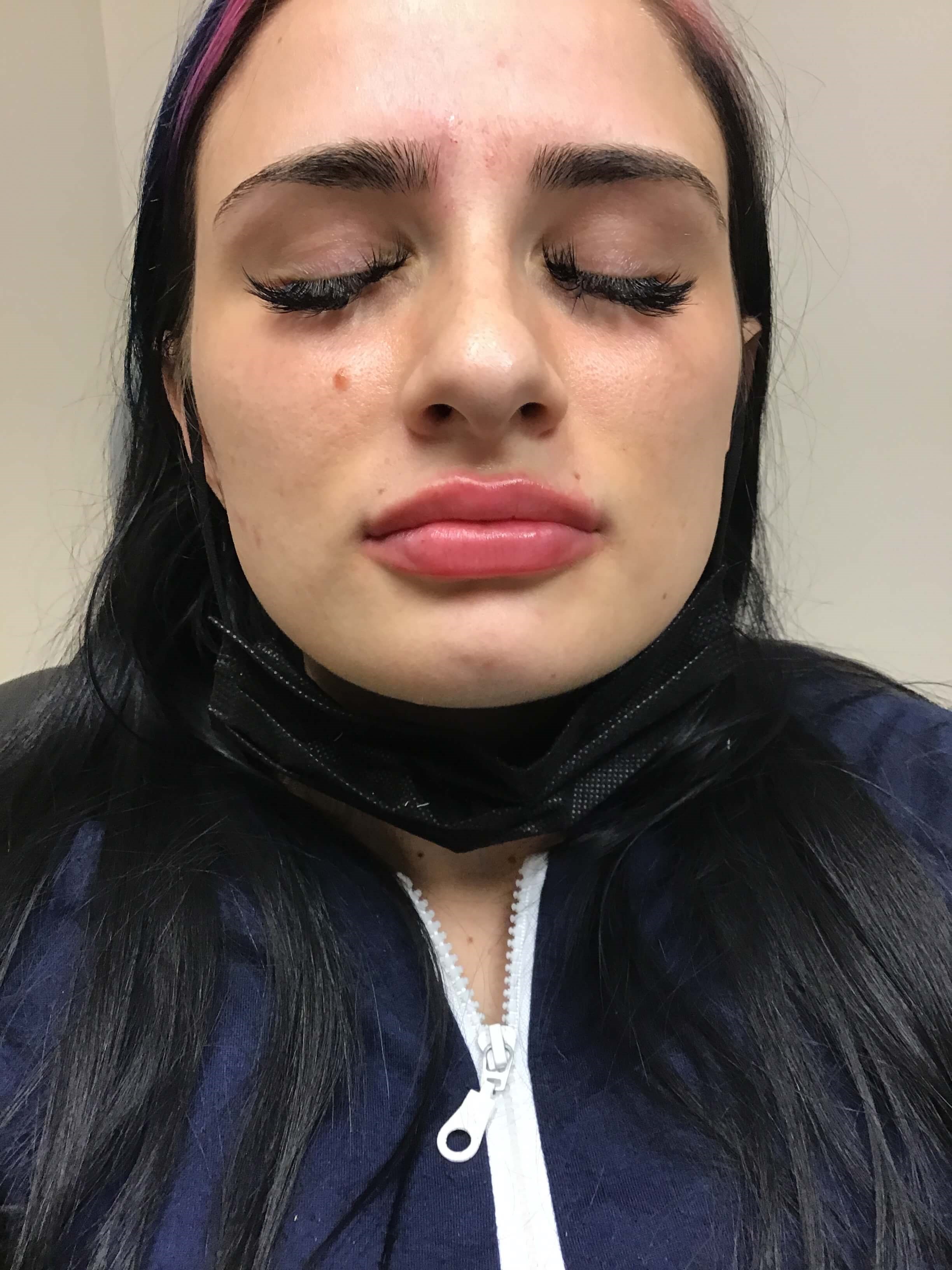Before and After Lip Filler After