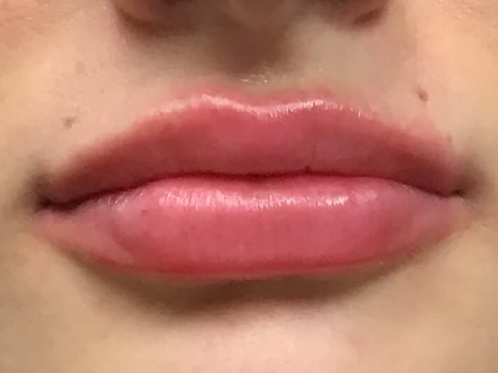Before and After Lip Filler After