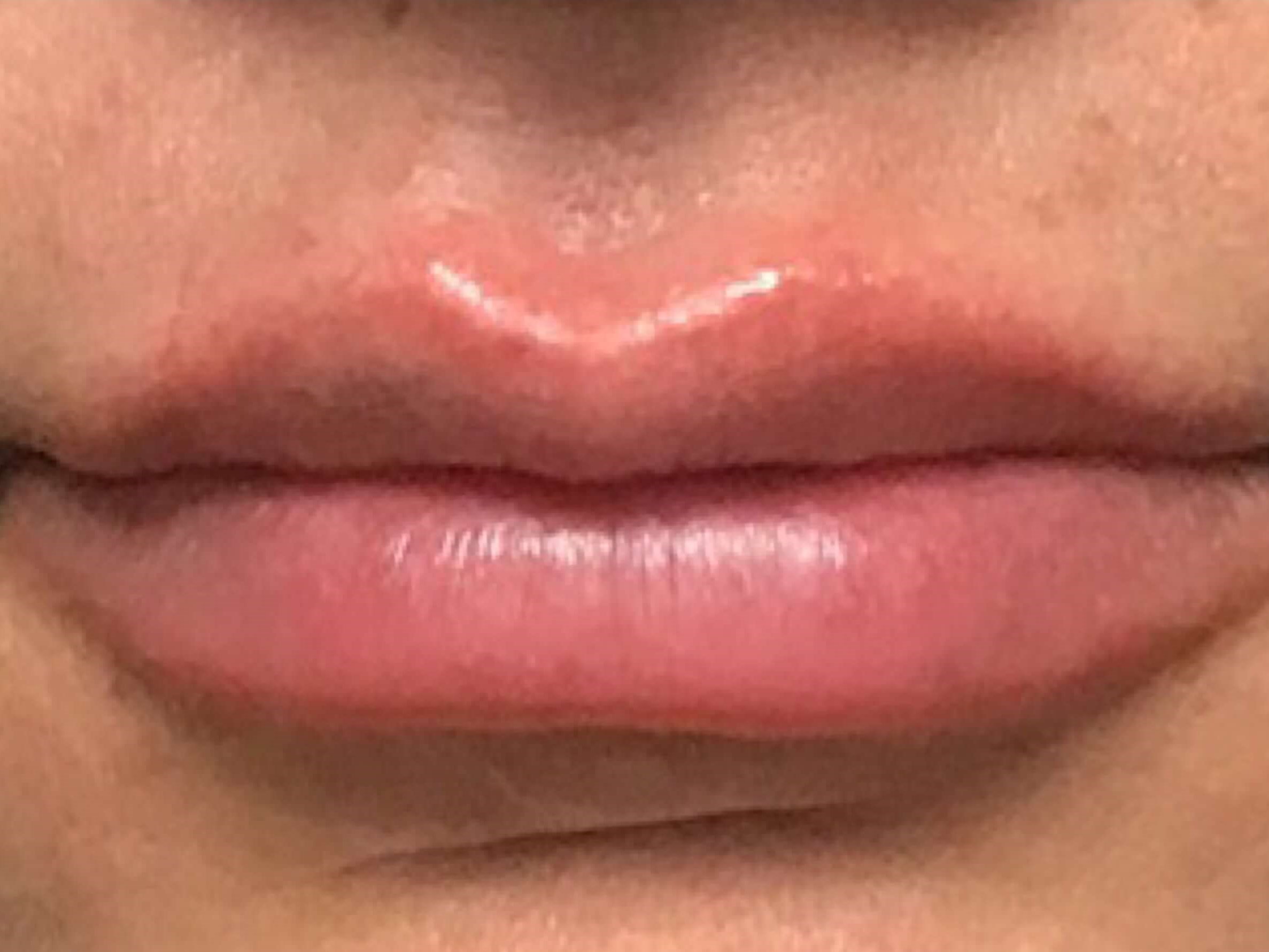 Before and After Lip Filler After