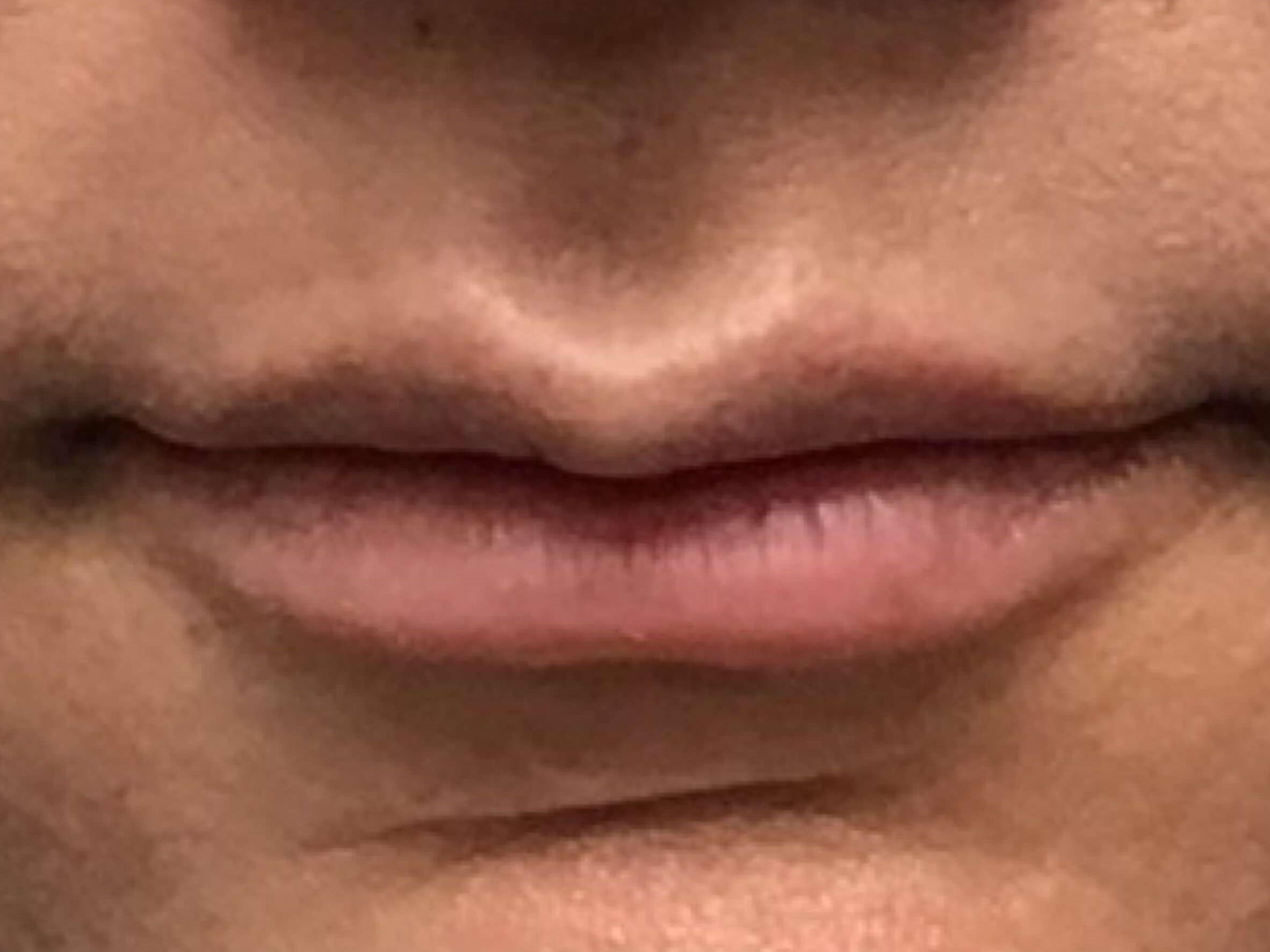 Before and After Lip Filler Before