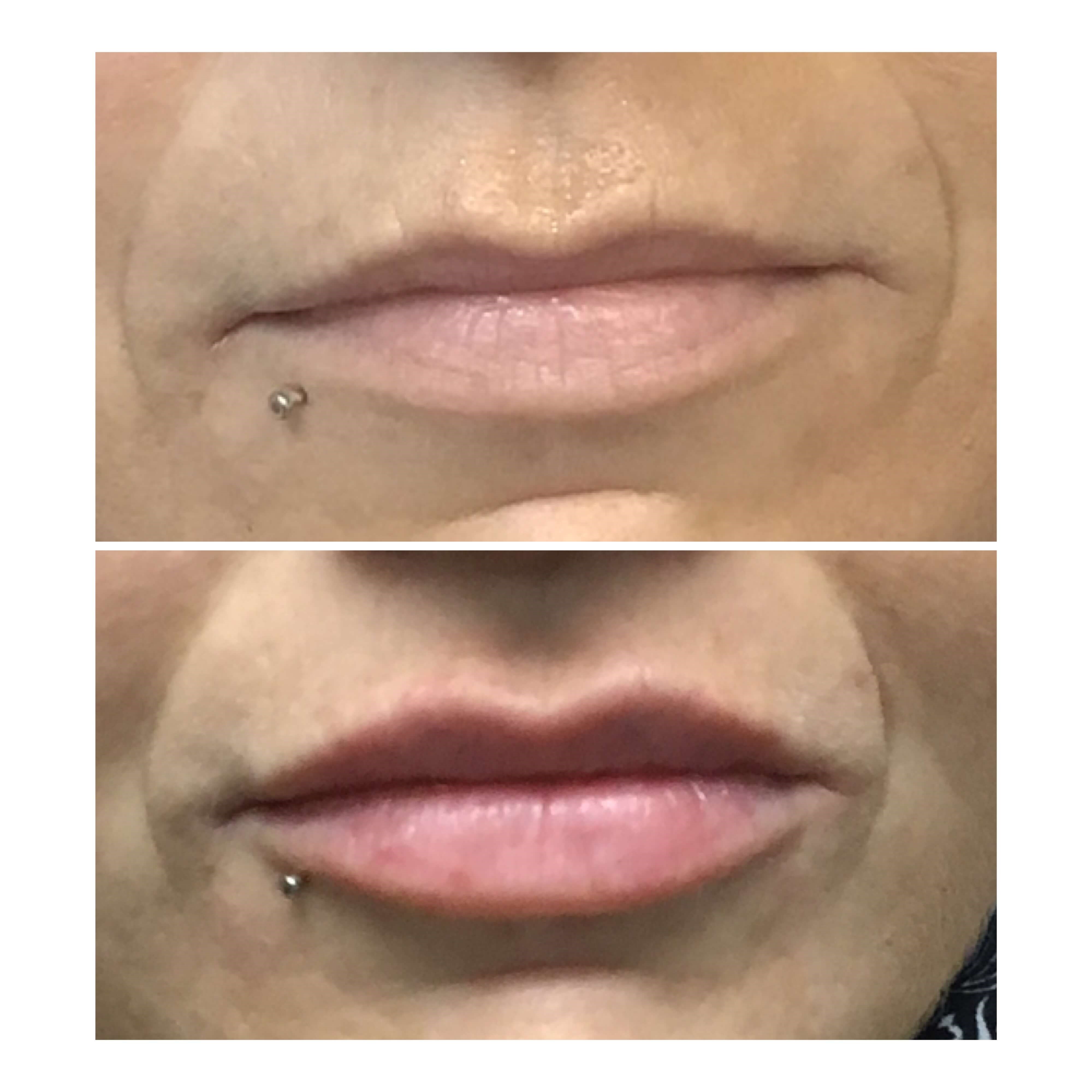 Before and After Lip Filler Before