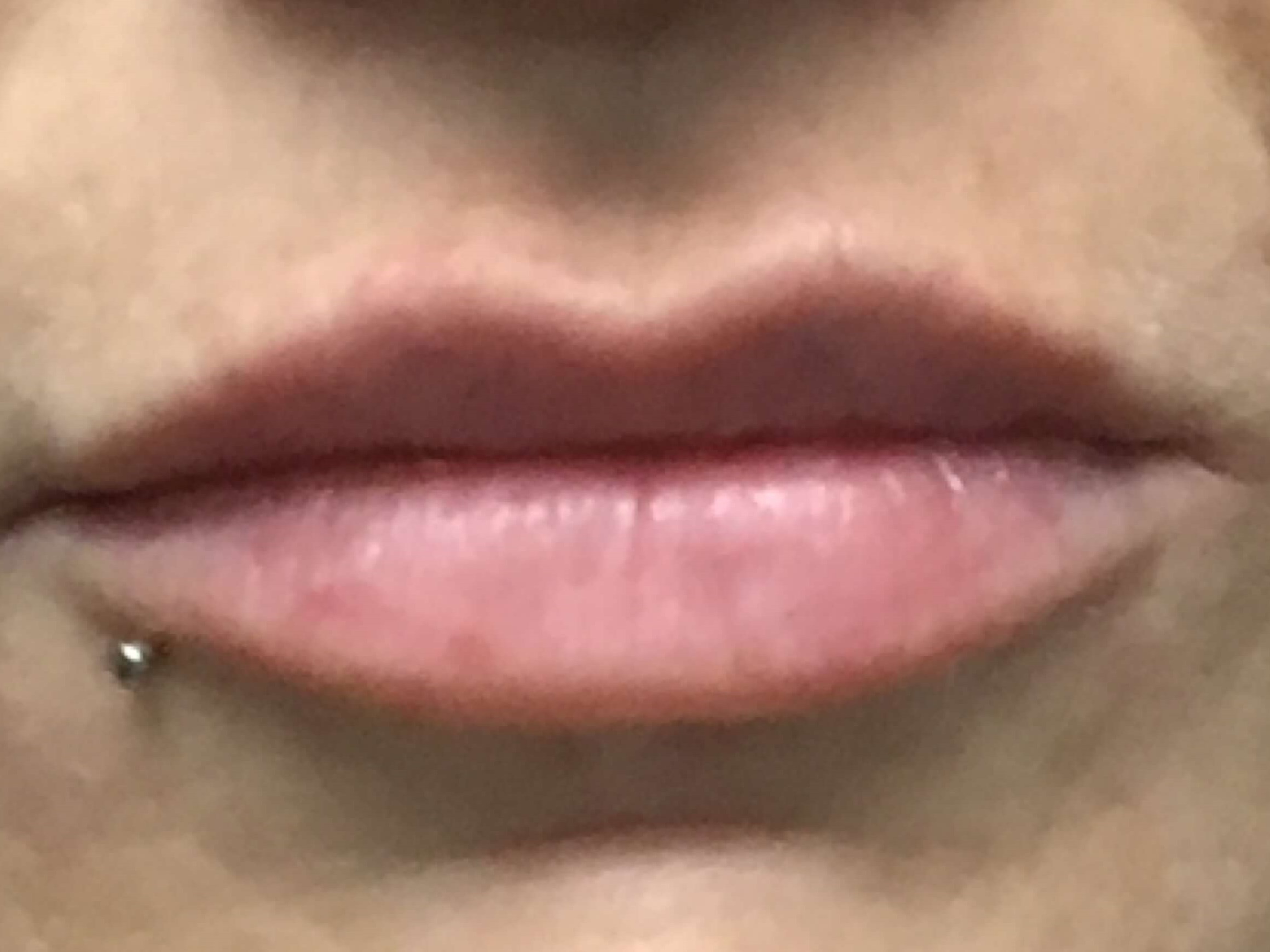 Before and After Lip Filler After
