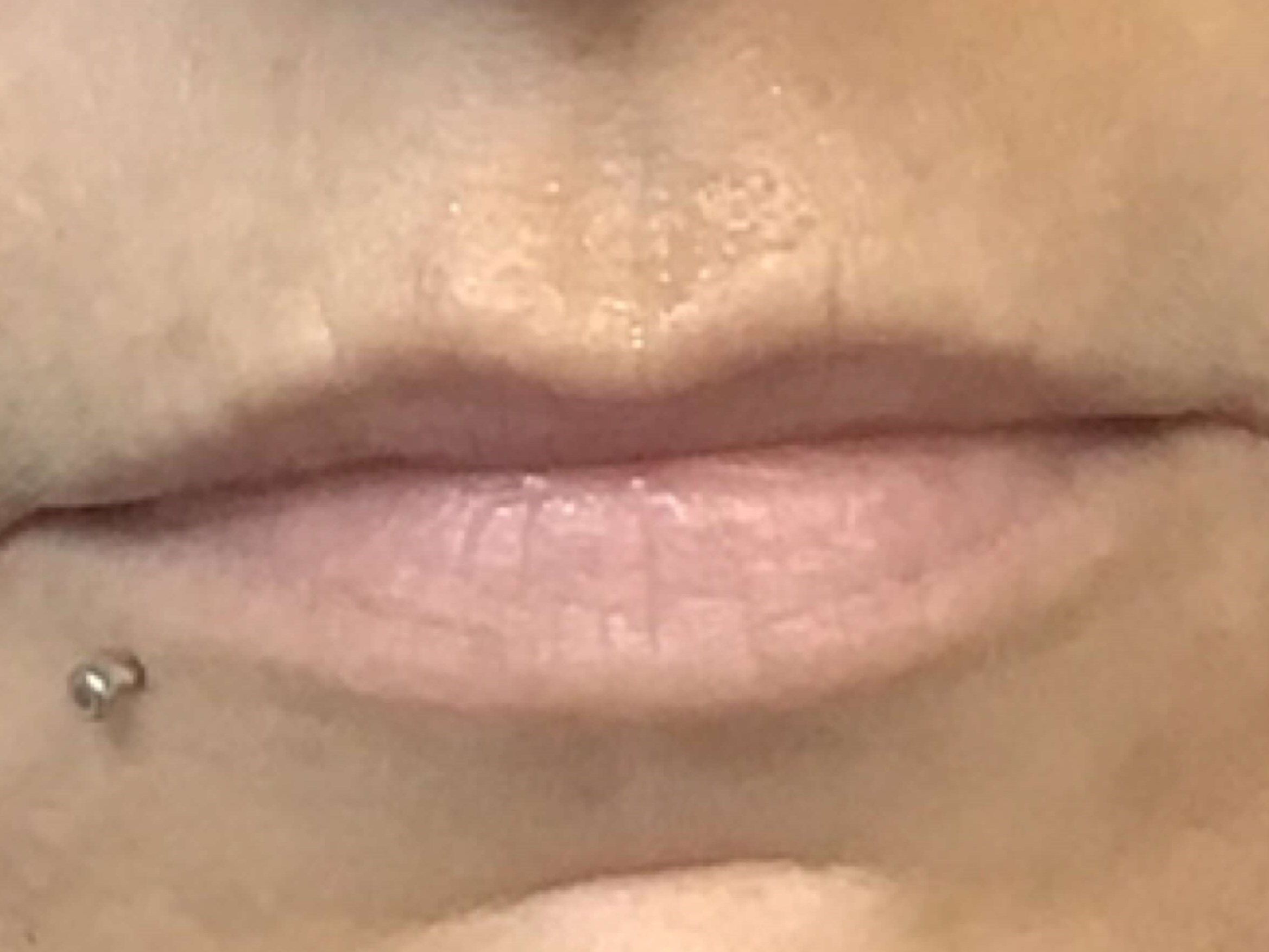 Before and After Lip Filler Before