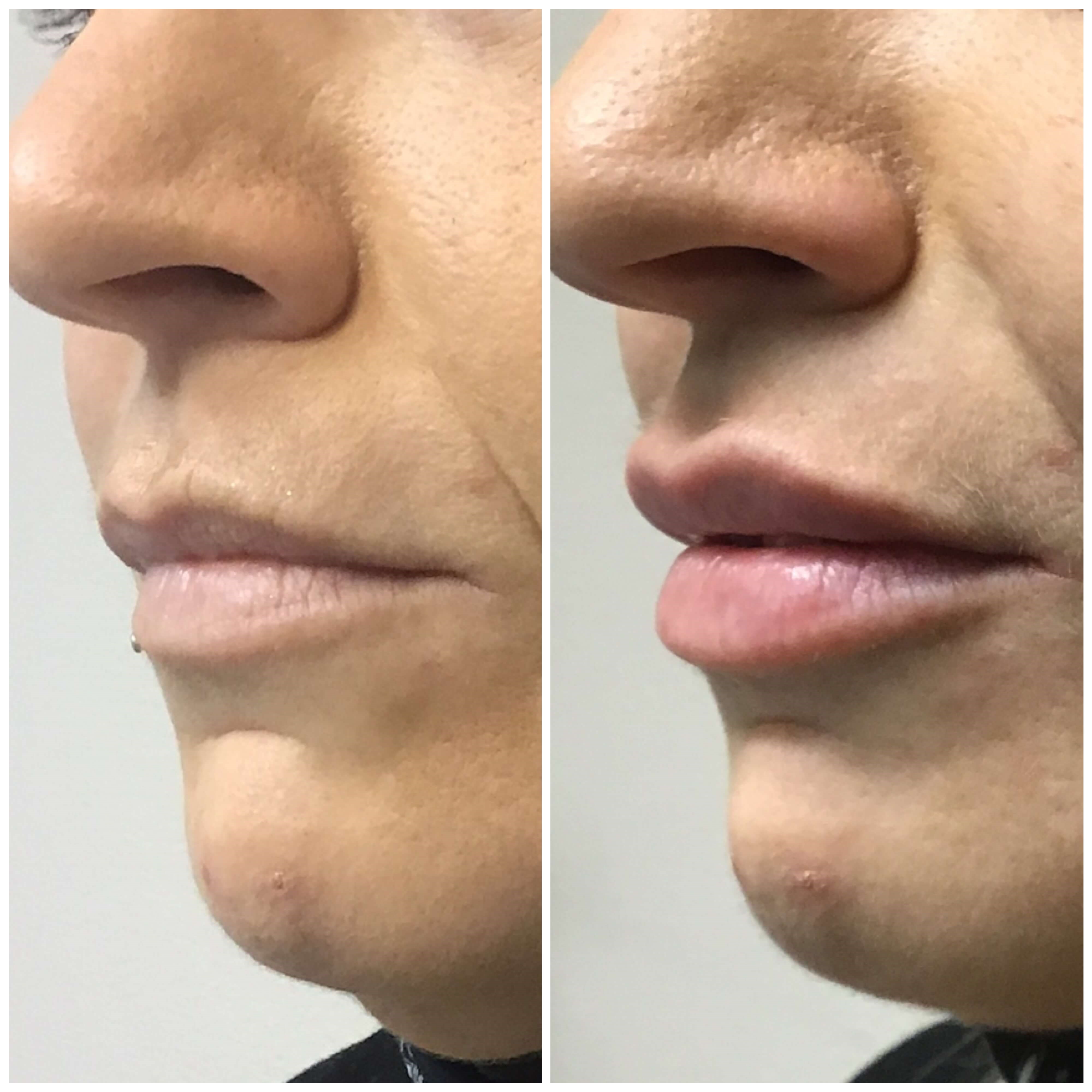 Before and After Lip Filler Before