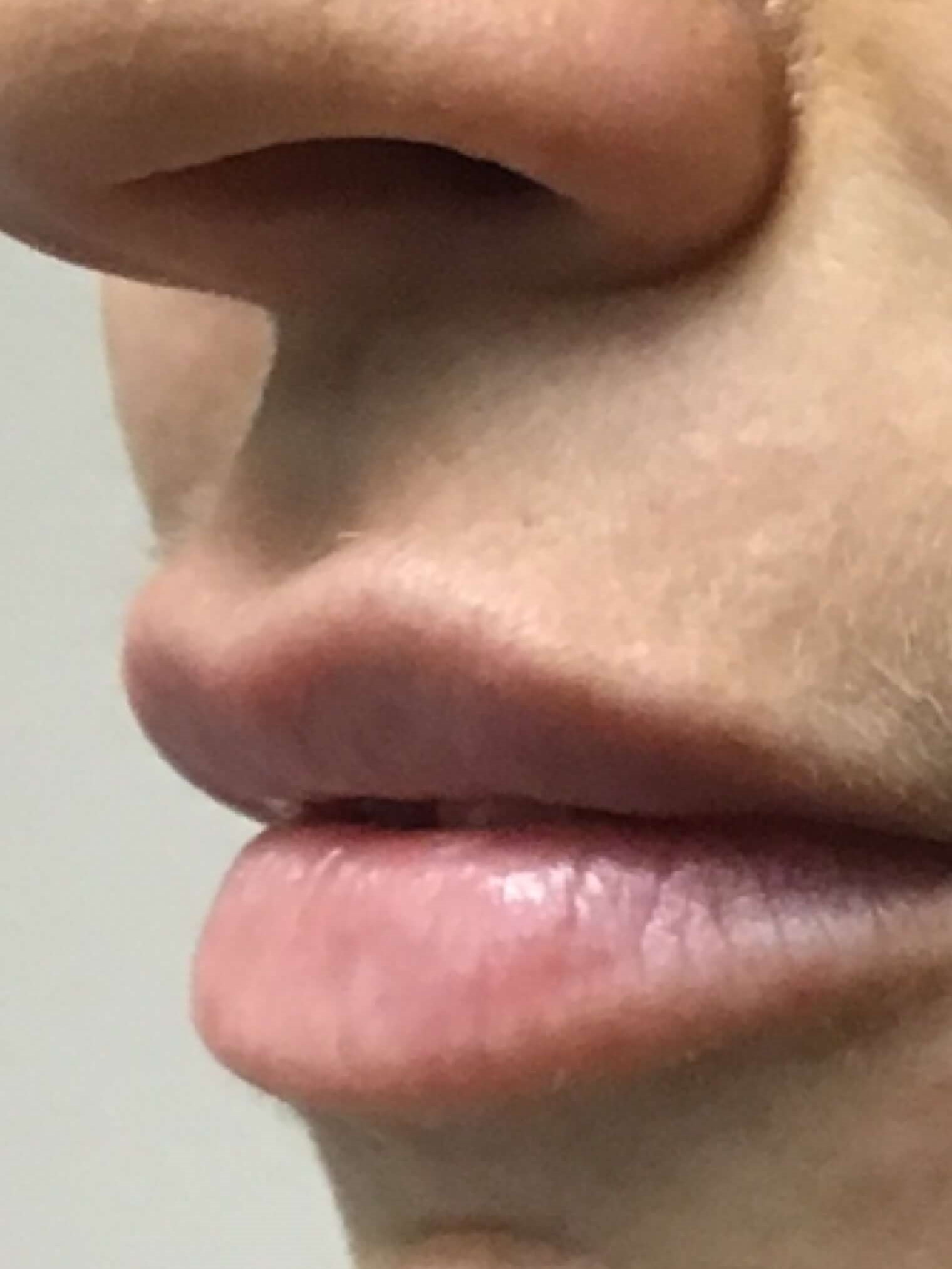 Before and After Lip Filler After