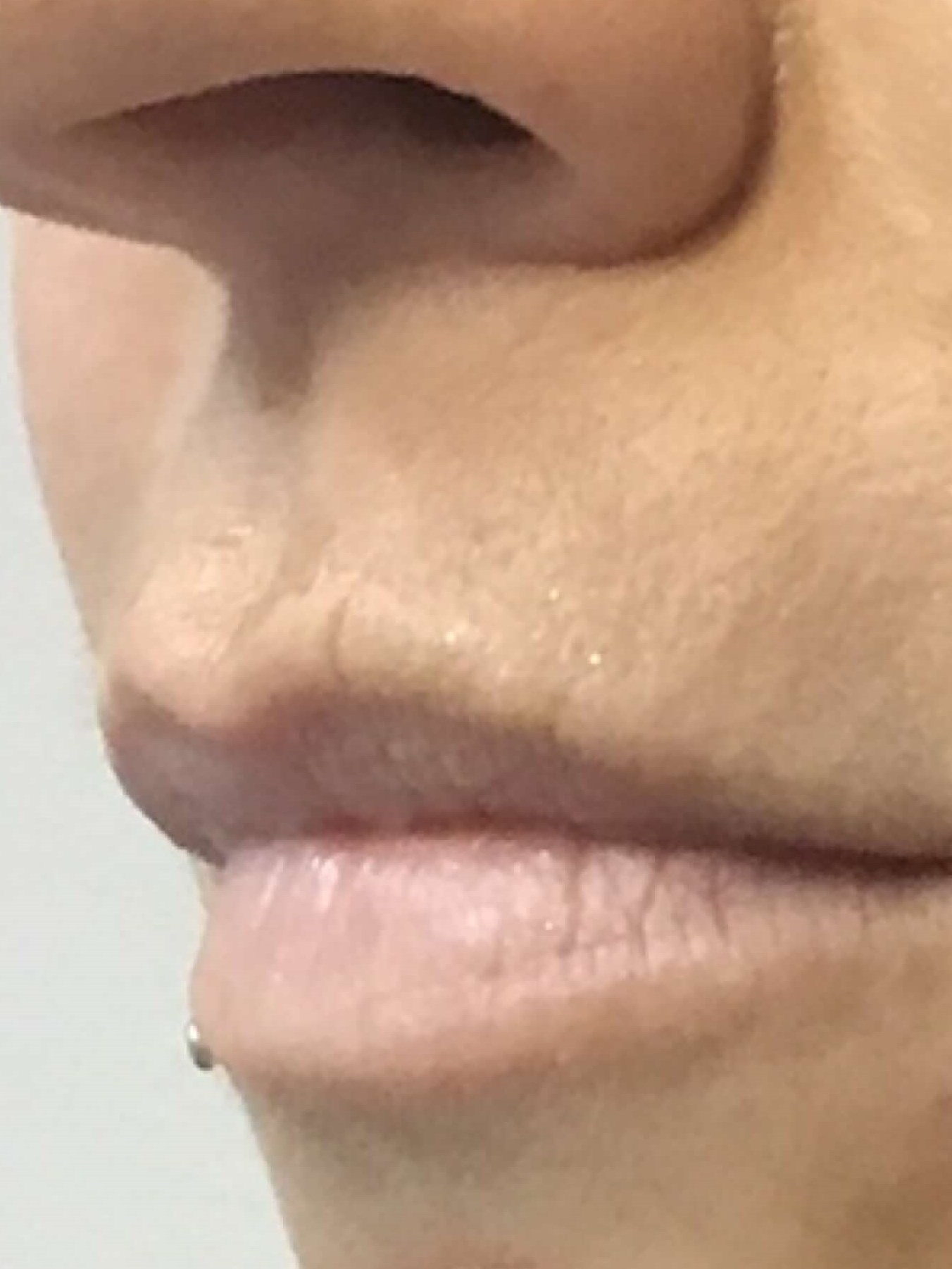 Before and After Lip Filler Before