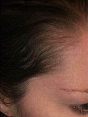 Before & After Hair Regrowth After