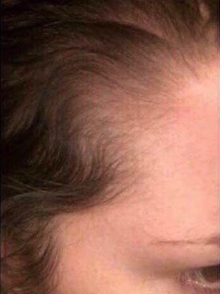 Before & After Hair Regrowth Before