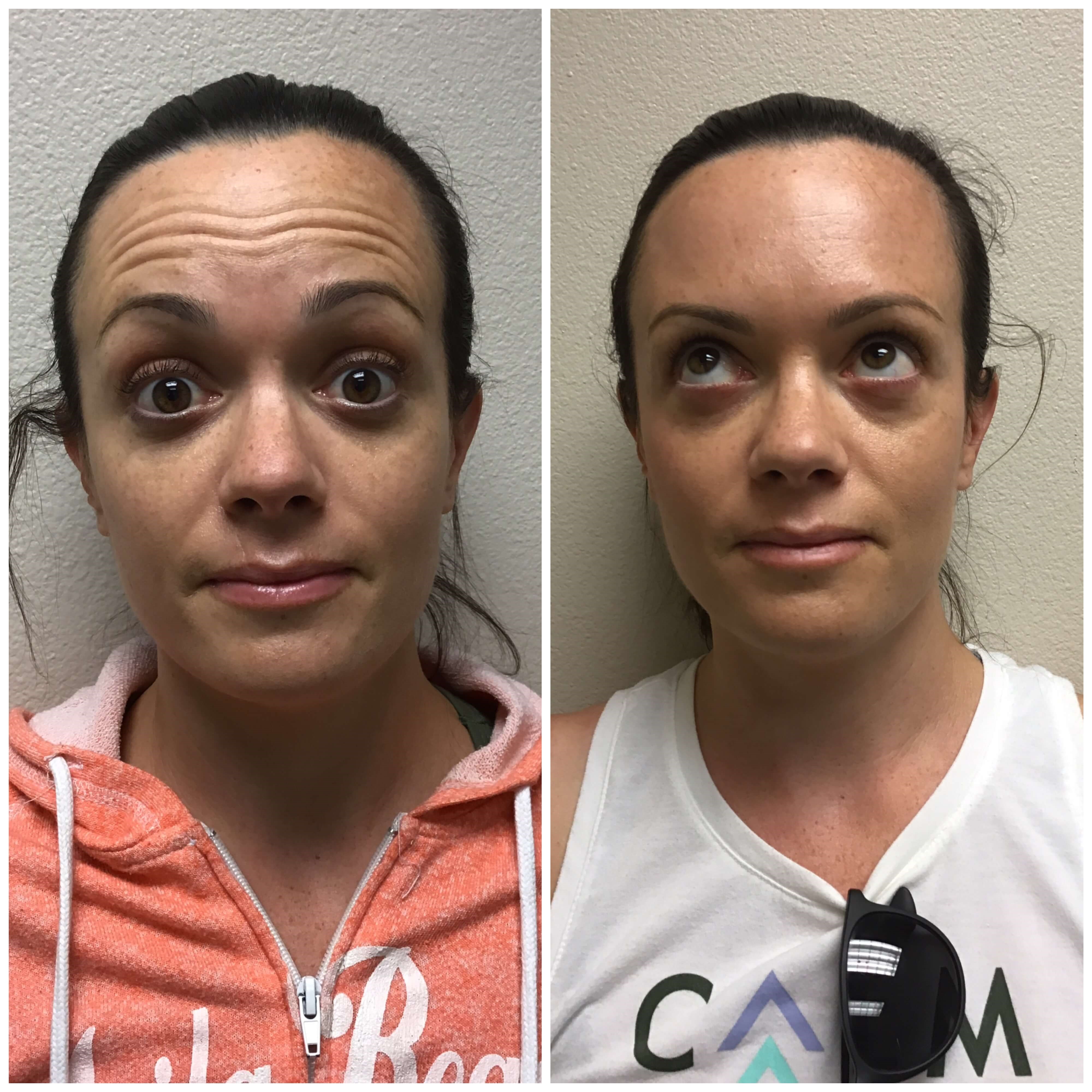 Before & After Botox Before