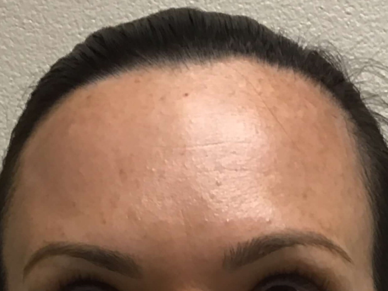 Before & After Botox After