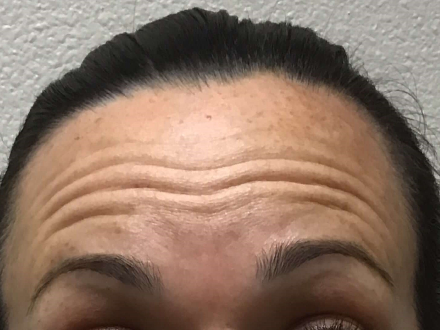 Before & After Botox Before