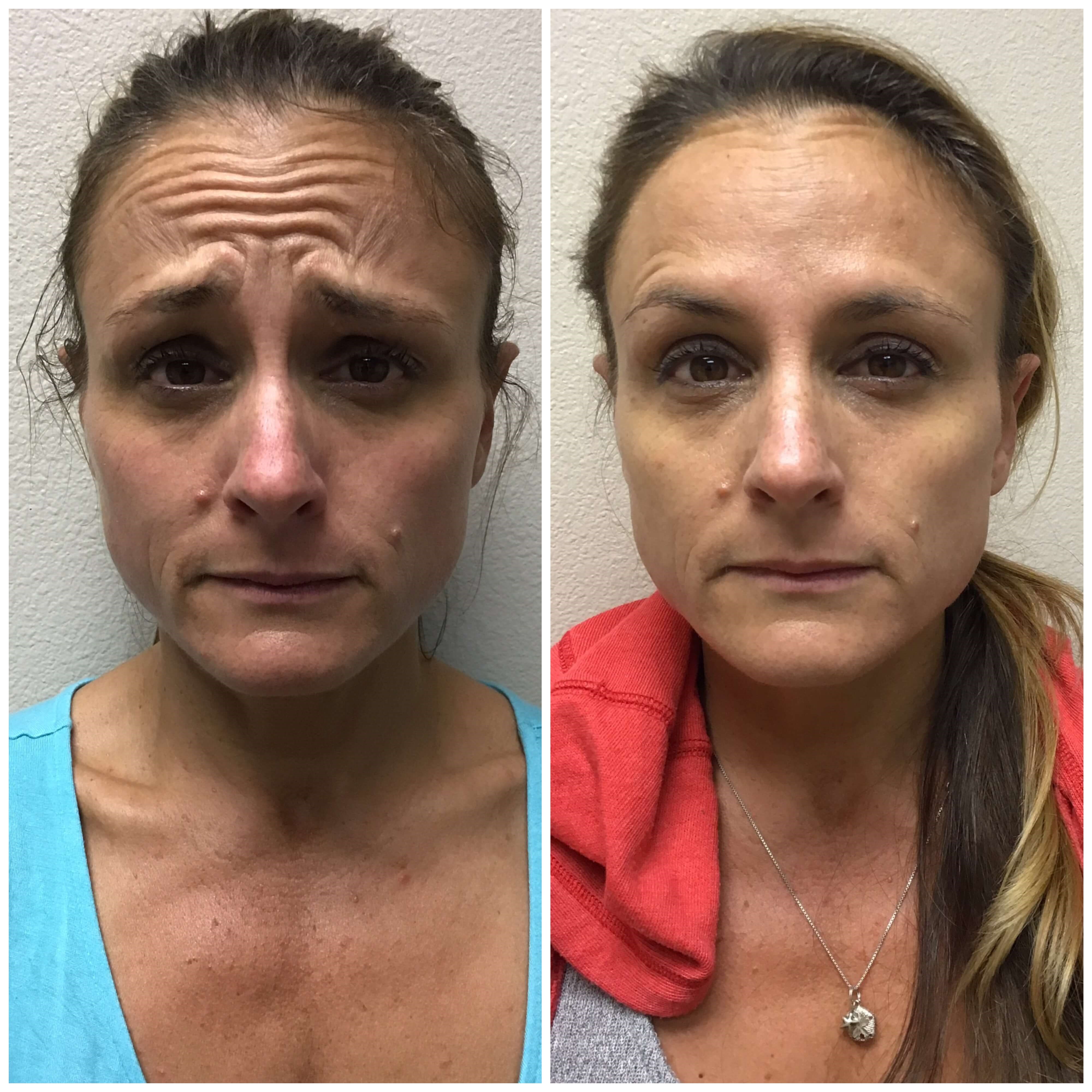 Before and After Botox Before