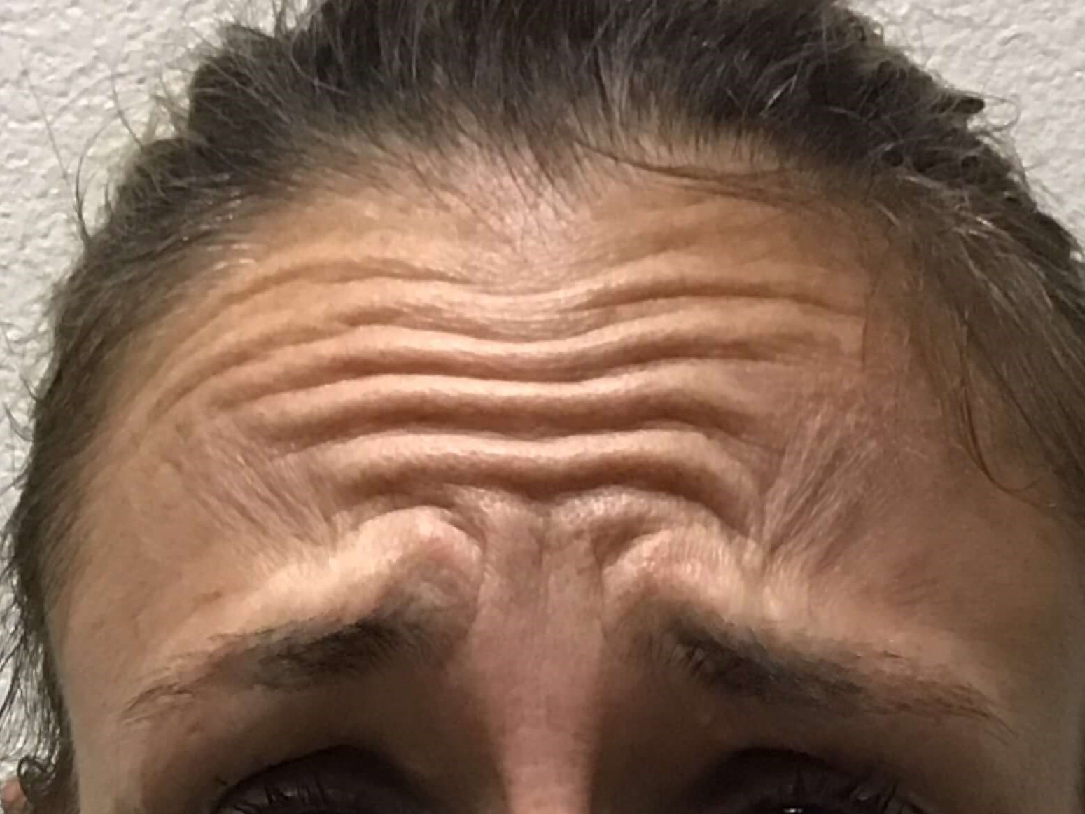 Before and After Botox Before