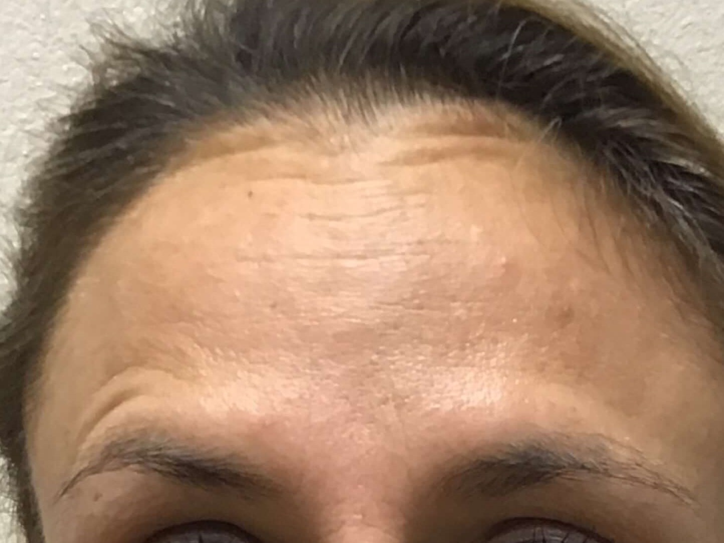 Before and After Botox After