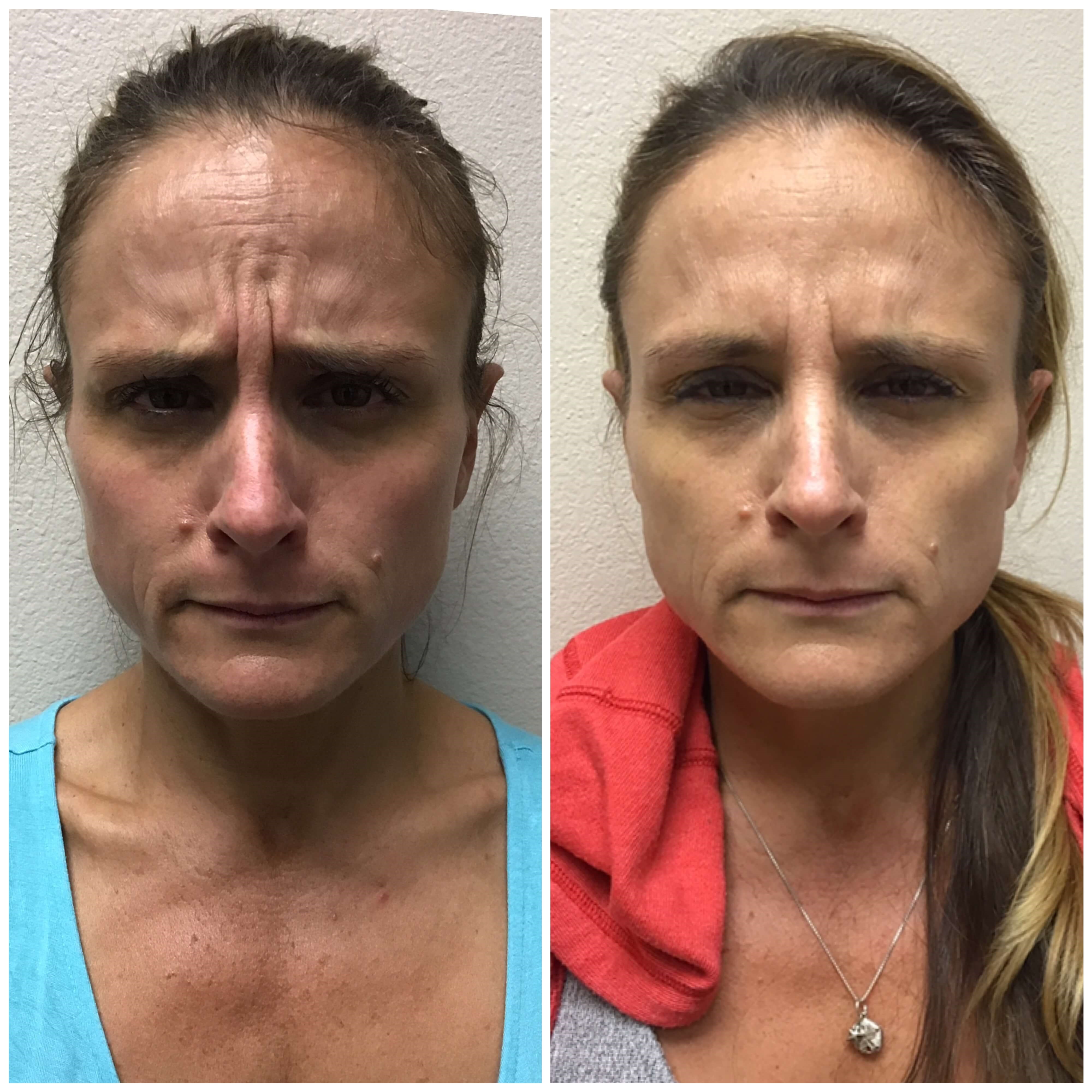 Before and After Botox Before