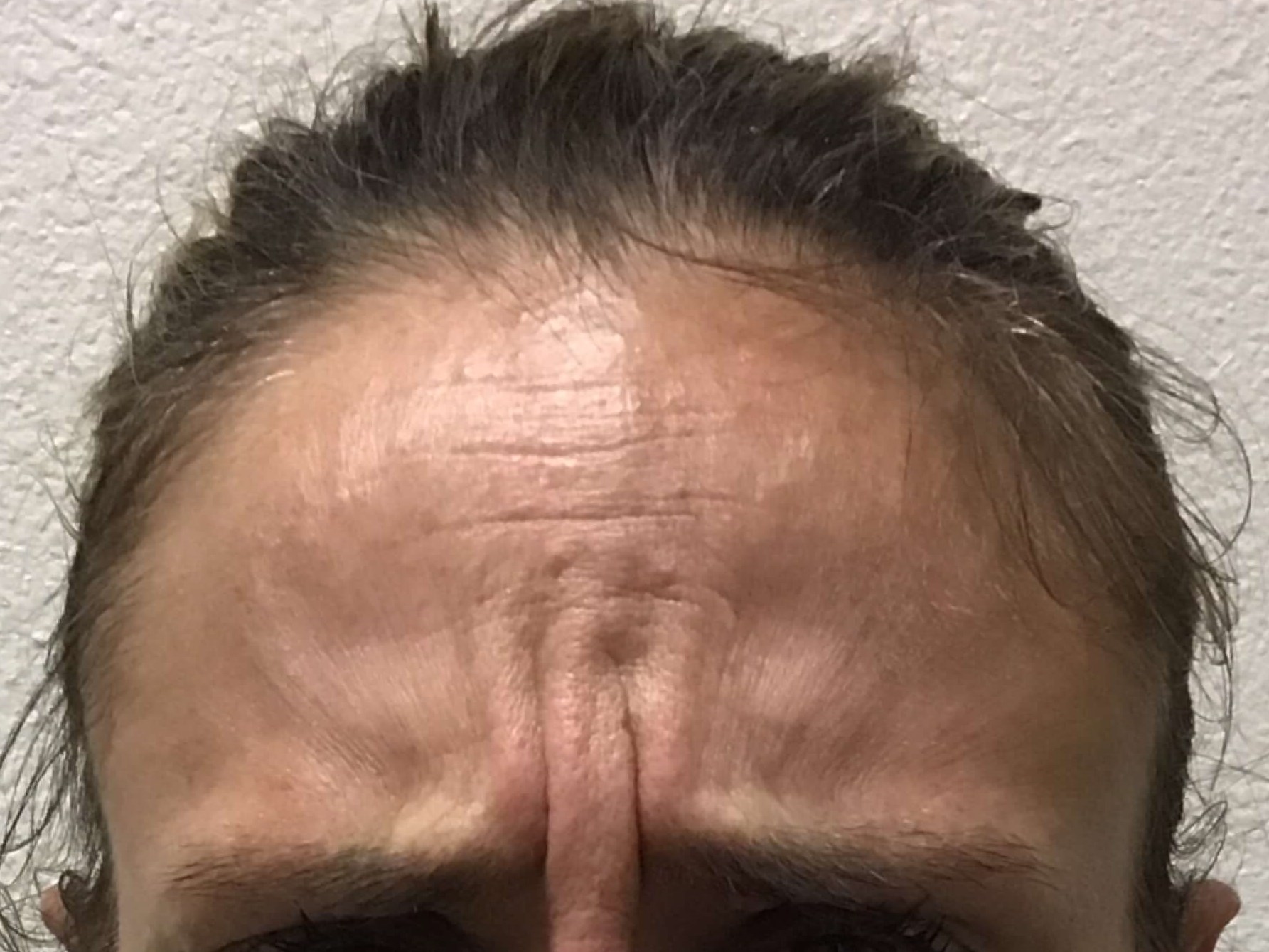 Before and After Botox Before